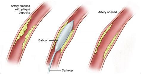 Angioplasty Singapore Procedure By Experienced Surgeon