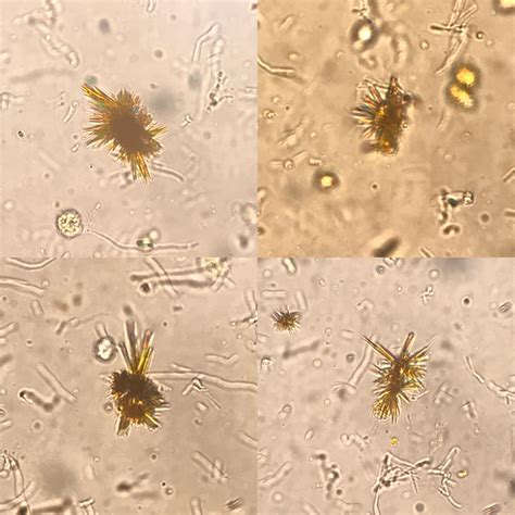 Bilirubin crystals in urine from a patient with alcoholic cirrhosis : r/medlabprofessionals