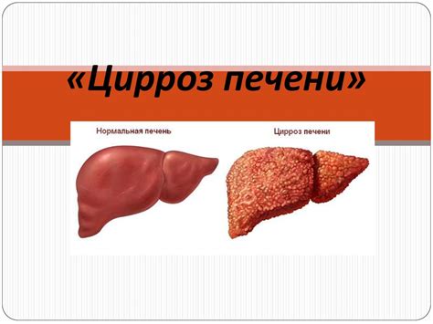 Цирроз печени - online presentation