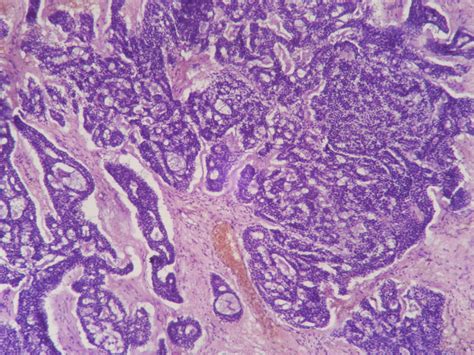 Adenoid Cystic Carcinoma Histopathologyguru