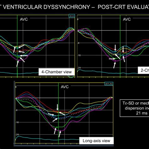 Same Patient Of Fig 1 After Cardiac Resynchronization Therapy Crt