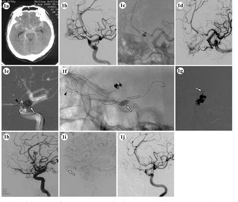 Figure From Transarterial Embolization Of Dural Arteriovenous