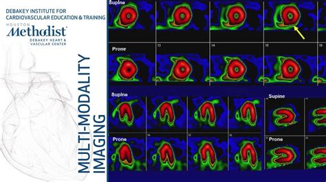 Nuclear Medicine Scan Heart