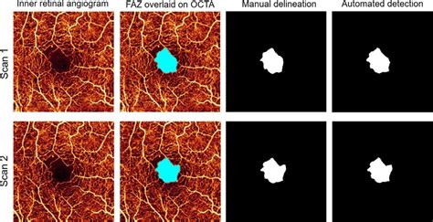 Foveal Avascular Zone Determined By The Automated Algorithm And Manual Download Scientific