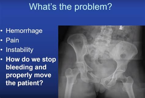 Pelvic fracture Basics — OrthopaedicPrinciples.com