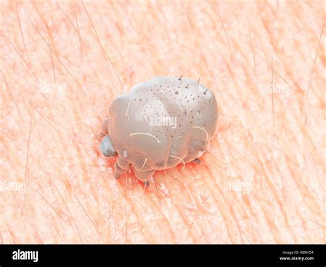 Scabies Mites Skin Hi Res Stock Photography And Images Alamy