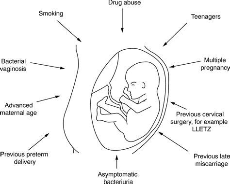 Management Of Preterm Labour ADC Fetal Neonatal Edition