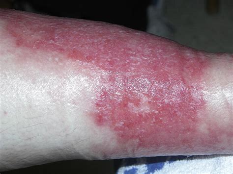 Lower Limb Cellulitis And Its Mimics Journal Of The American Academy Of Dermatology