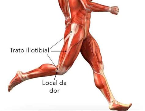 Síndrome da banda iliotibial ou joelho do corredor Clínica Dr