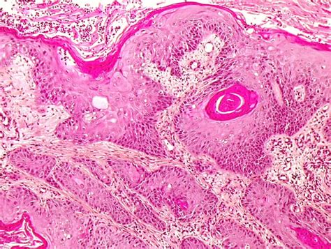 Histopathology Of The Uterine Cervix Digital Atlas