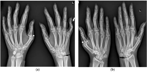 Jcm Free Full Text Hand And Wrist Involvement In Seropositive