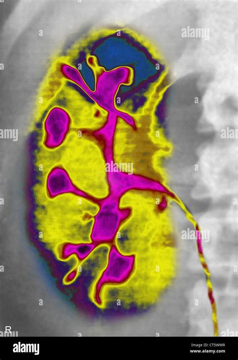 La Enfermedad Poliqu Stica Del Ri N Rayos X Fotograf A De Stock Alamy