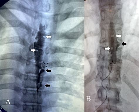 Use Of Epidurography In The Perioperative And Acute Pain Setting