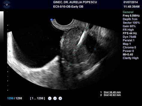 Ecografie Endovaginala Cabinet Ginecologic