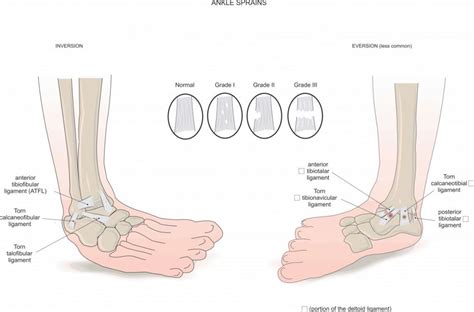 Tipos Y Grados De Esguinces De Tobillos EstudioFisio