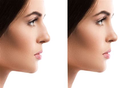 Rhinoplastie Ethnique Pour Suisses Guide Complet Et Tarifs