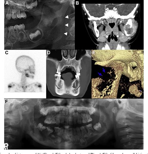 Figure 1 From Hypothetical Pathogenesis Of Eosinophilic Infiltration In Langerhans Cell