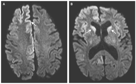 Creutzfeldt-jakob Disease: Causes and Symptoms | Healthtian