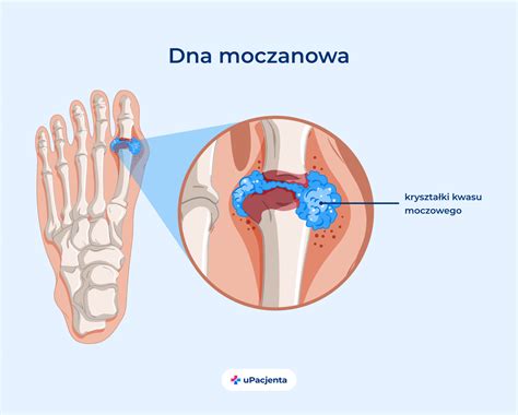 Dna Moczanowa Objawy Przyczyny Leczenie