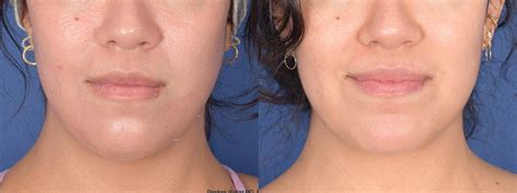 Chin Implant Before And After Weber Facial Plastic Surgery