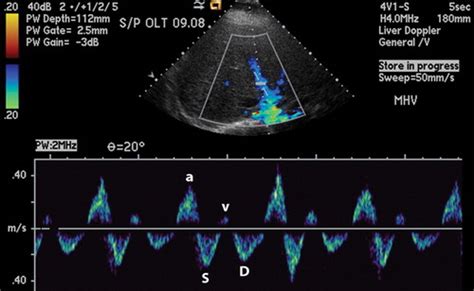 Doppler Us Of The Liver Made Simple Radiographics