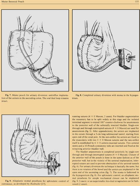 Urinary Diversion Highlights European Urology