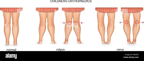 Vector Illustration Of Pediatric Orthopedics Valgus And Varus Stock