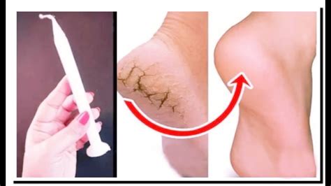 Remove Cracked Heels And Get Beautiful Feet Magical Cracked Heels Home Remedy Healthcare