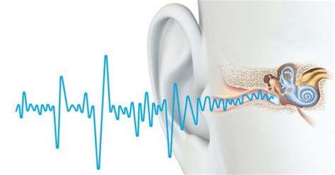 Comment soigner les acouphènes naturellement Conseils Sante dz