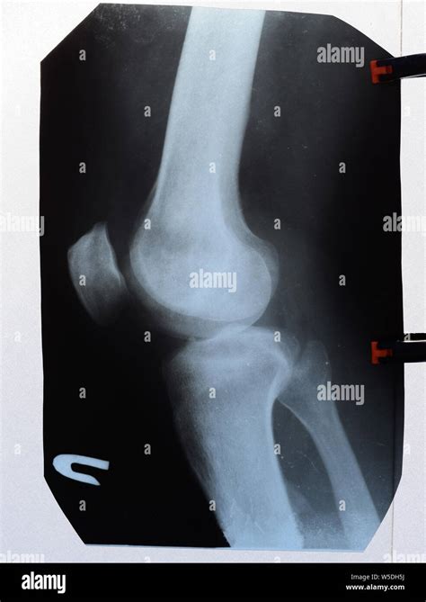 X-ray of the knee joints, a picture of the bones of the knee on the x-ray Stock Photo - Alamy