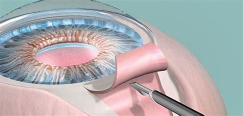 Cirurgia De Glaucoma CEV Oftalmologia