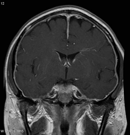 Spontaneous intracranial hypotension | Radiology Reference Article | Radiopaedia.org