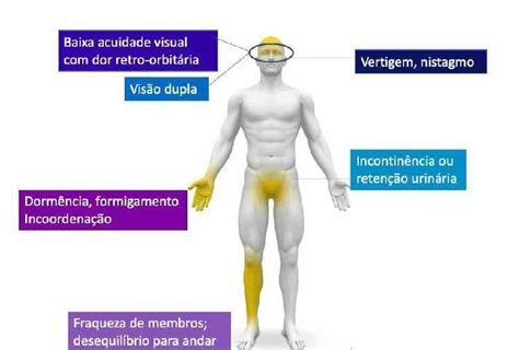 Fui diagnosticada esclerose múltipla aos 26 diz jovem Saúde