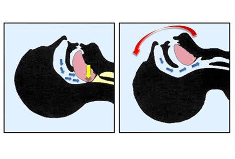 Management Of Upper Airway Trauma Emergency Medicine