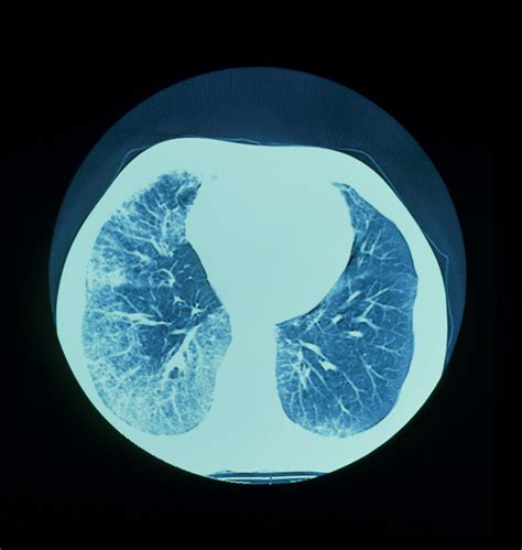 Systemic Sclerosis Life Expectancy - Rare Disease Advisor