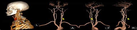 Clinical Observation And Nursing Experience Of Carotid Endarterectomy