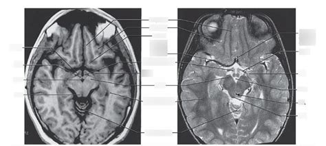 Inferior Colliculus Mri