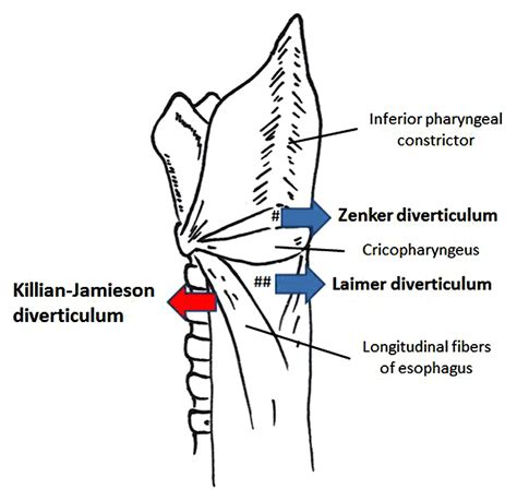 甲状腺腫瘍との鑑別を要したkillian Jamieson憩室の1例