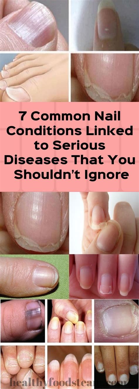 7 Common Nail Conditions Linked To Serious Diseases That You Shouldn’t Ignore Nail Conditions