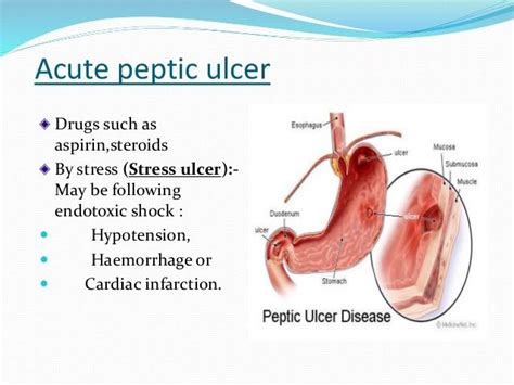 Acute Peptic Ulcer Ulcers Peptic Ulcer Stress