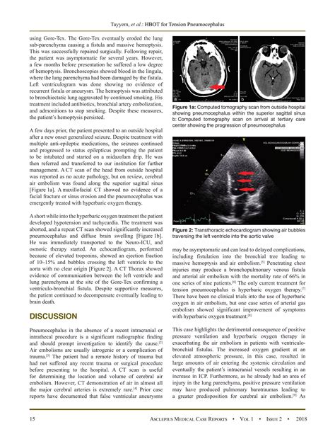 Worsening Tension Pneumocephalus From Late Post Traumatic Ventriculo