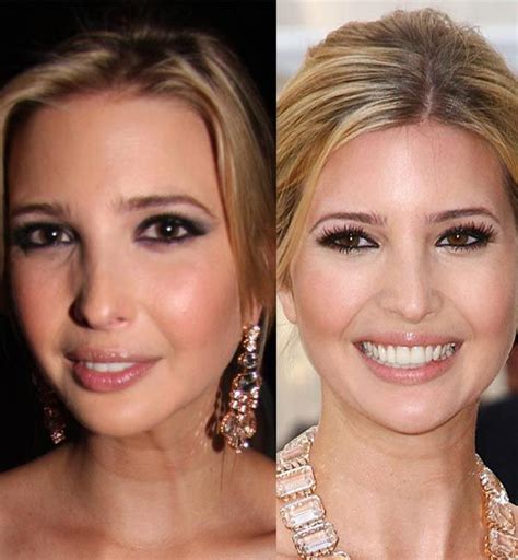 Ivanka Trump Plastic Surgery Before And After Always Interesting What