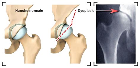 Proth Se De Hanche Par Voie Ant Rieure Mini Invasive Paris
