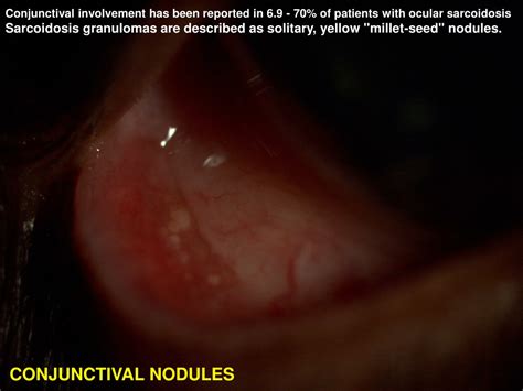 Ppt Ocular Manifestations Of Sarcoidosis Powerpoint Presentation Free Download Id9488825