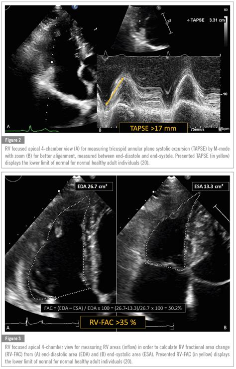 Echocardiographic Criteria For Athletes Heart With Cut Off Parameters