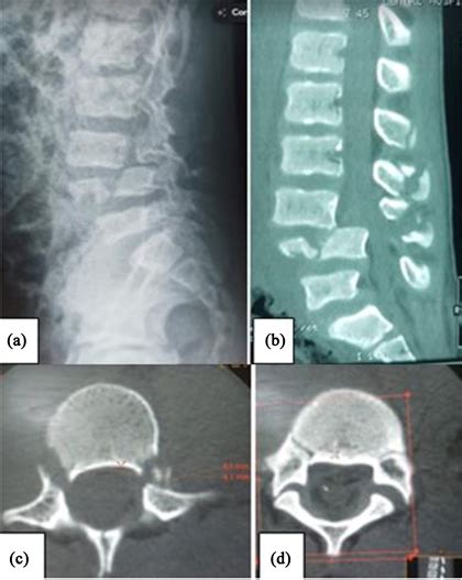 Pedicle Fracture