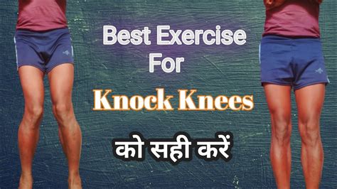 Best Exercise For Knock Knees Knock Knees को सही करें Fix Knock Knees Youtube