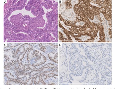 Figure 1 From Differences Between Low And High Grade Fetal Adenocarcinoma Of The Lung A