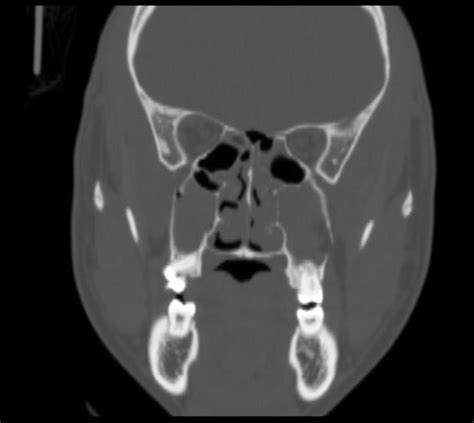 Le Fort Fracture Classification Radiology Reference Article