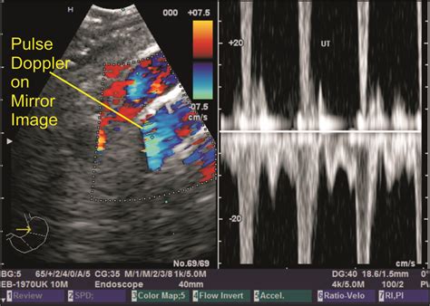 Techniques Of Linear Endobronchial Ultrasound Intechopen